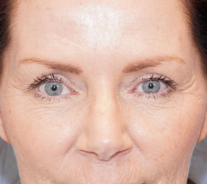 after blepharoplasty