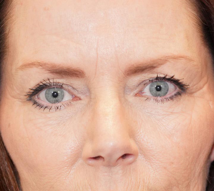 before blepharoplasty