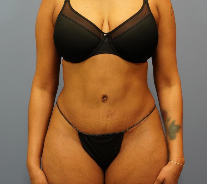 after liposuction