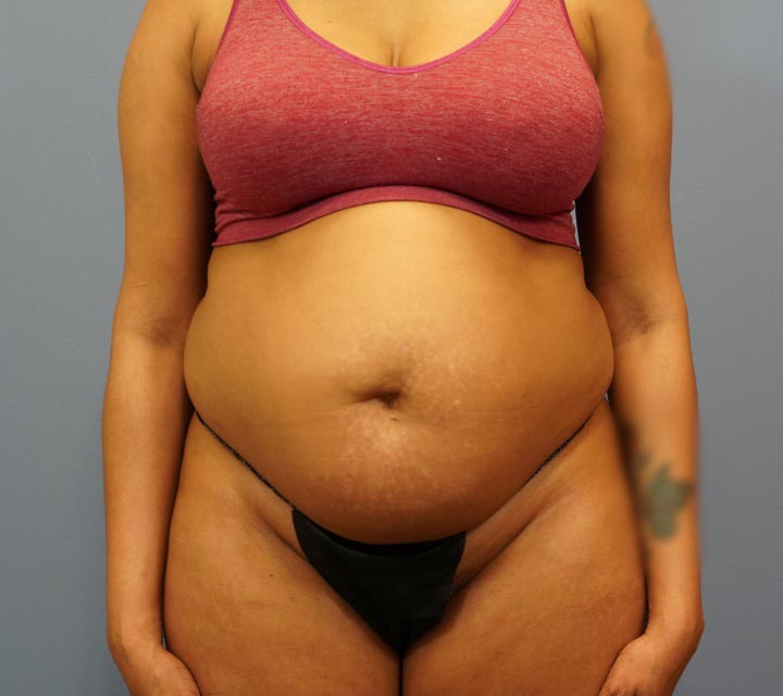 before liposuction