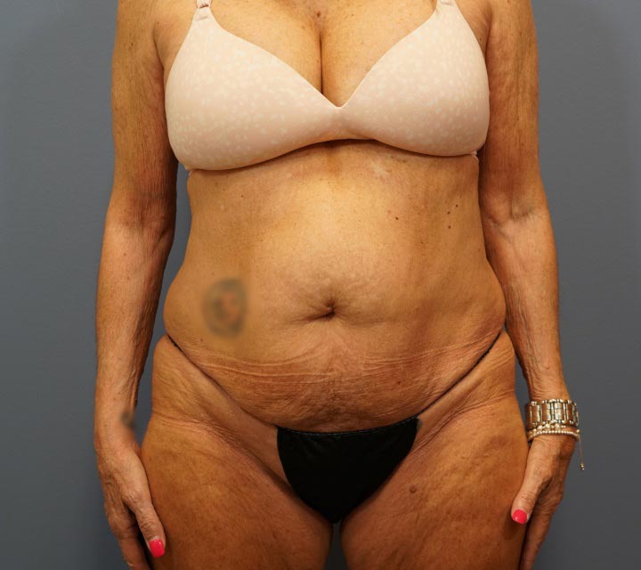 before tummy tuck