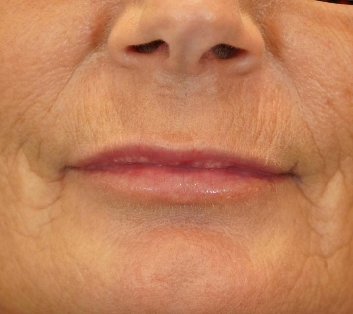 after lip fillers