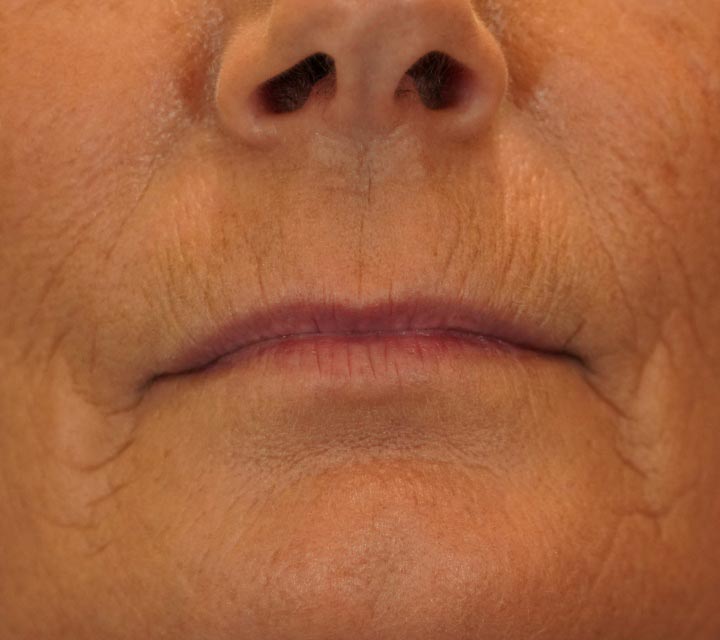 before lip fillers