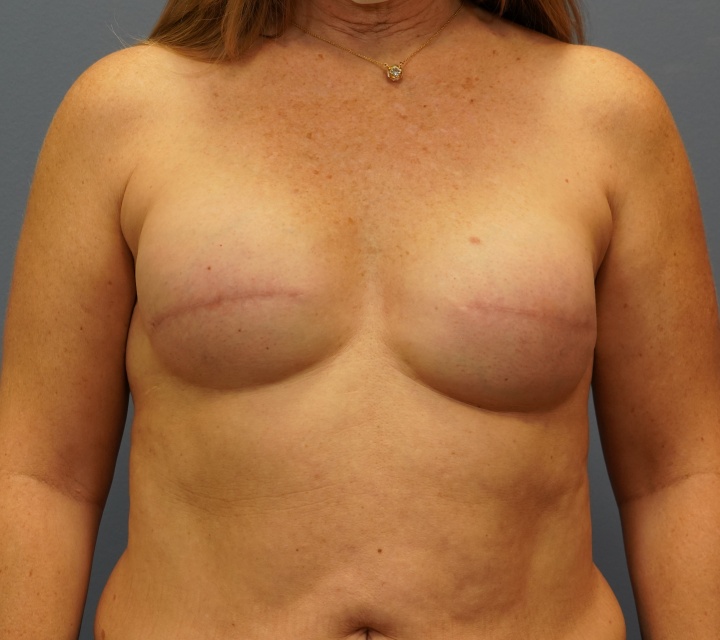 Close-up of breast reconstruction results after cancer treatment, Carmel,