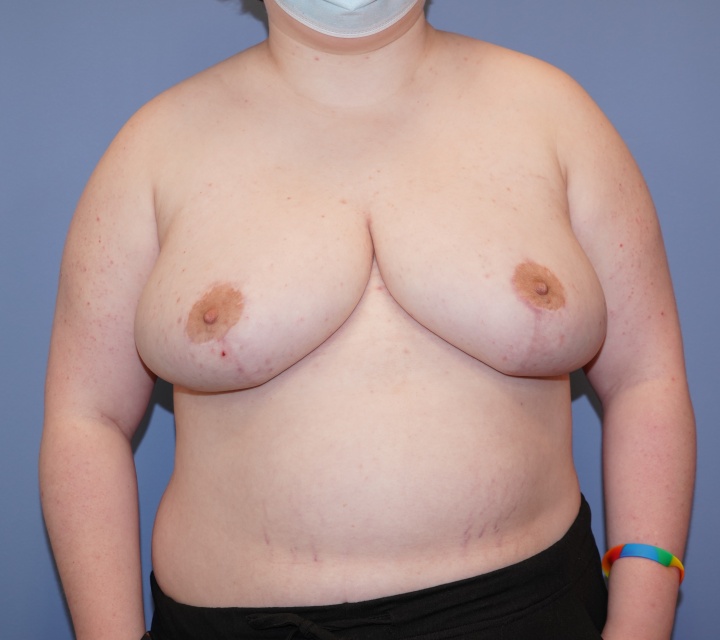 breast reduction before and after