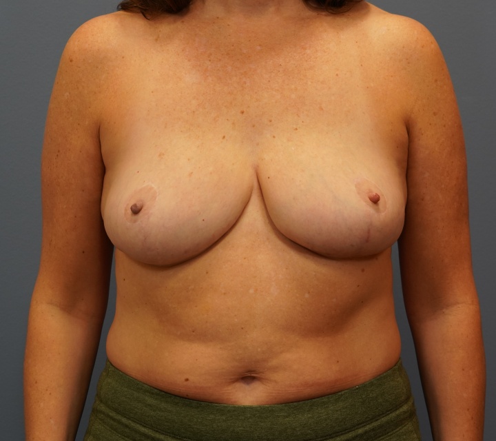 breast reduction before and after