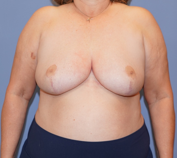 breast reduction before and after