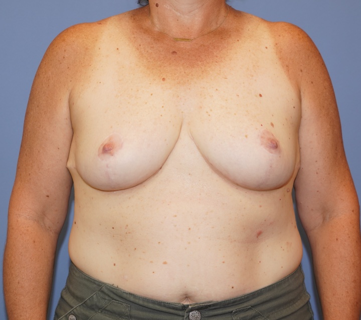 breast reduction before and after