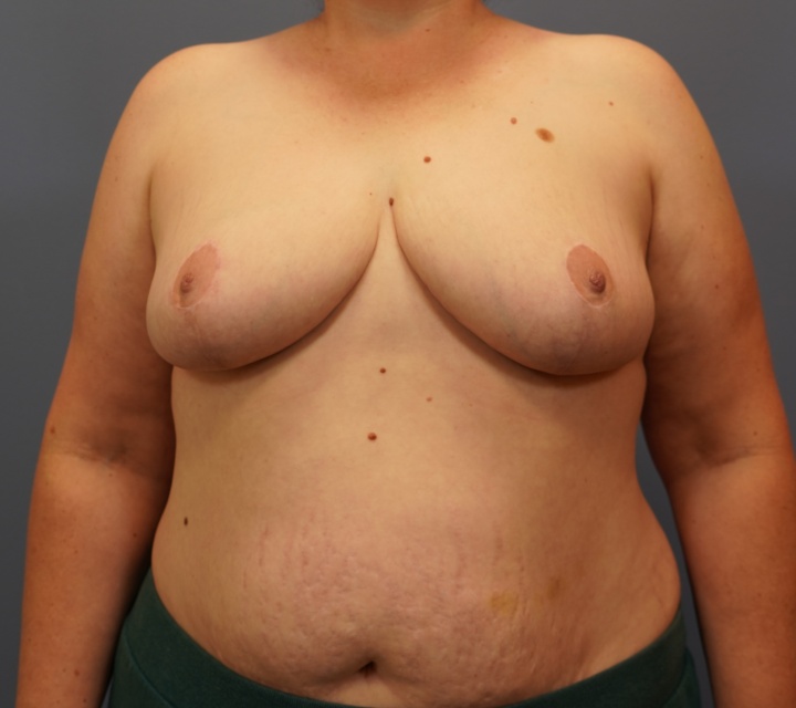 breast reduction before and after