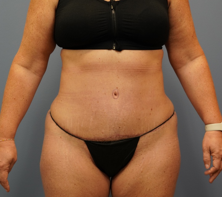 after liposuction
