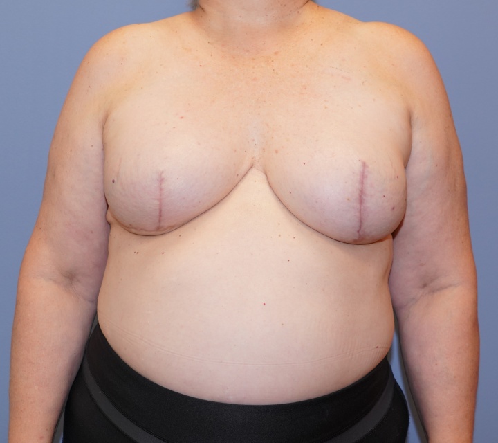 breast cancer reconstruction