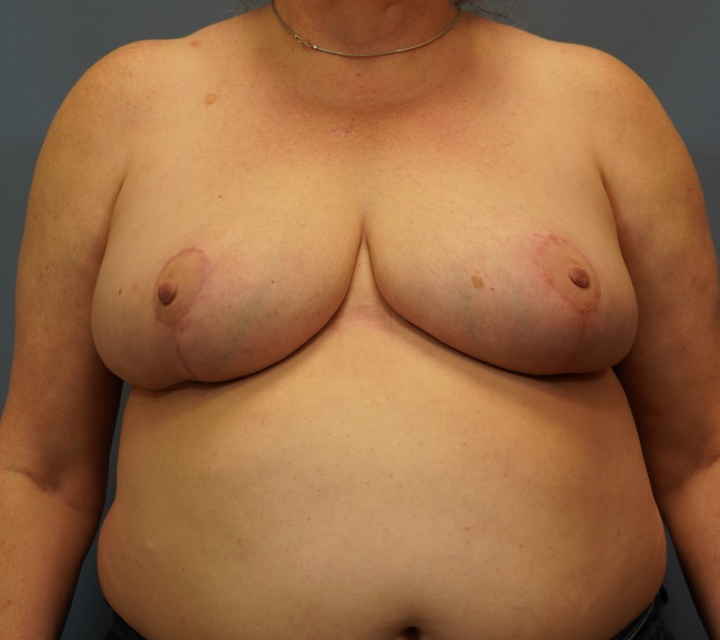 breast cancer reconstruction