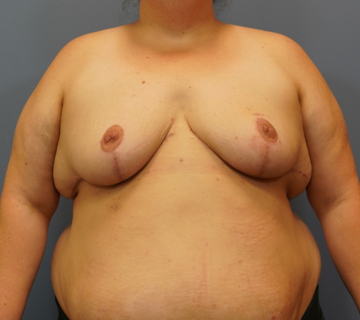 breast reduction before and after