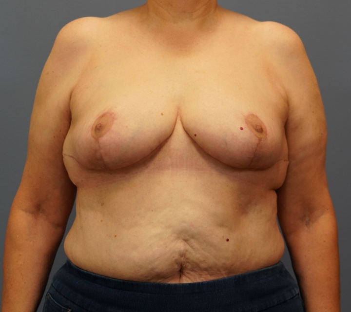 breast reduction before and after