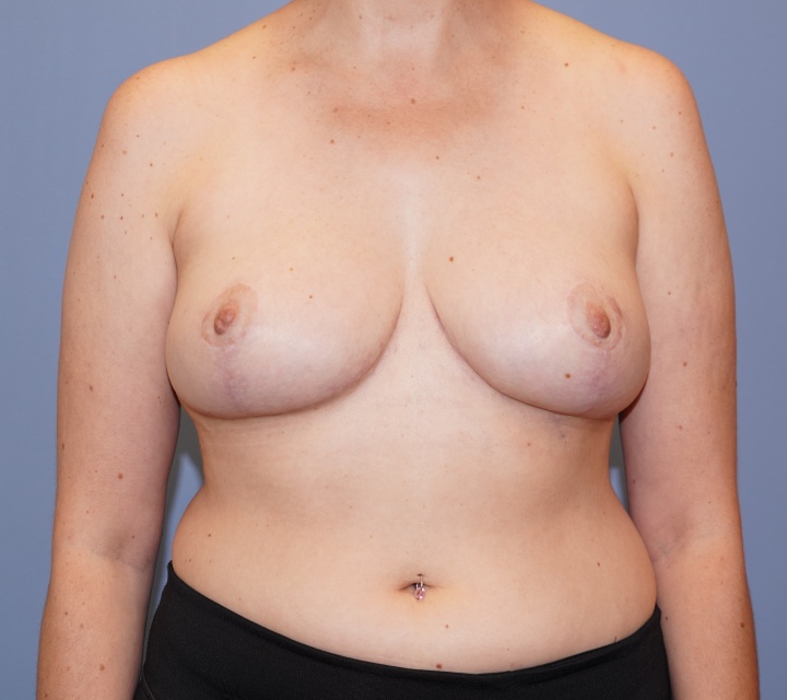 breast reduction before and after