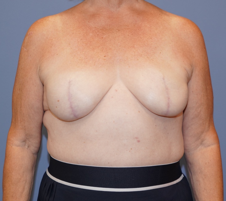 breast cancer reconstruction