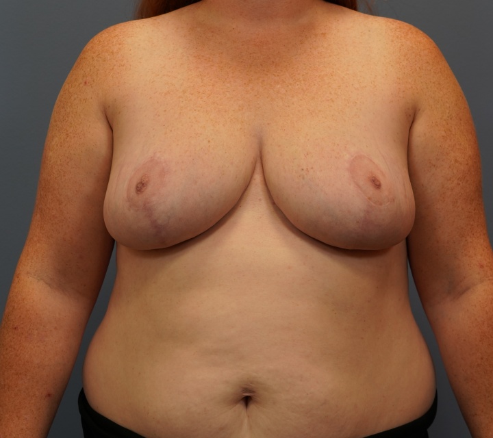 breast reduction before and after