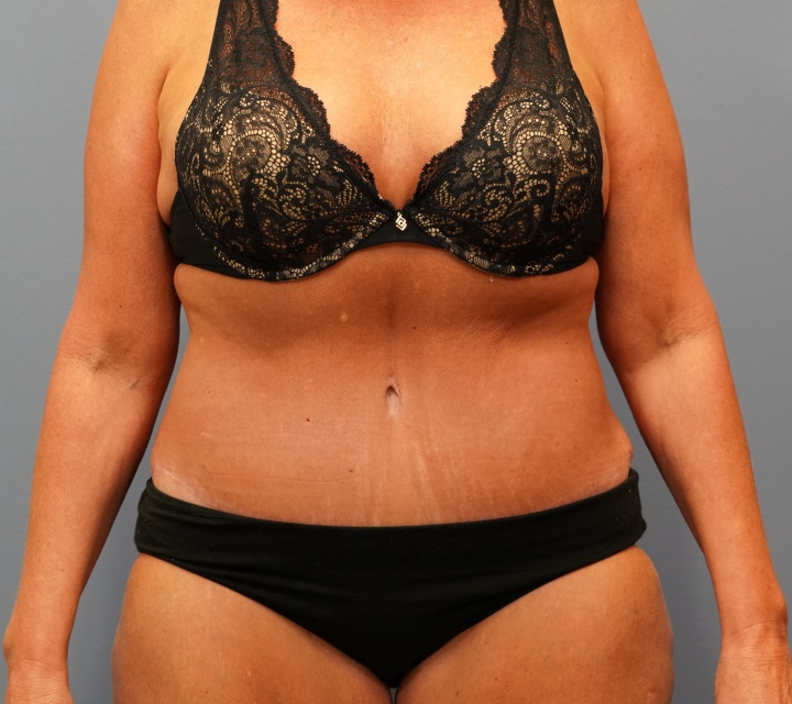 after tummy tuck