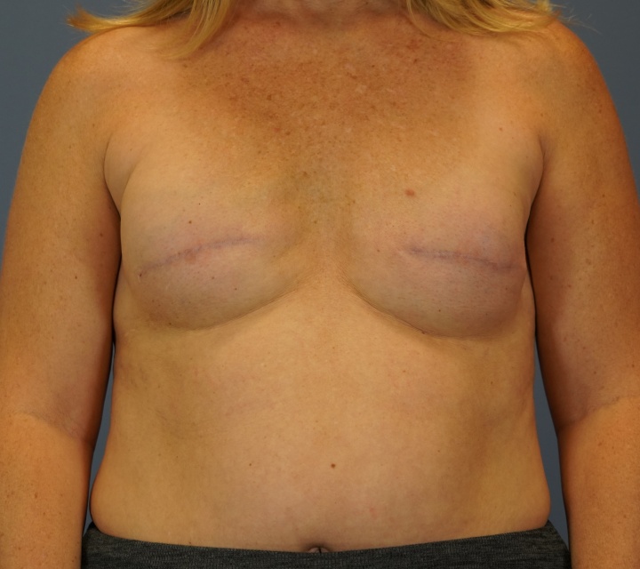 breast cancer reconstructionPatient showing breast reconstruction after cancer surgery, Carmel, IN