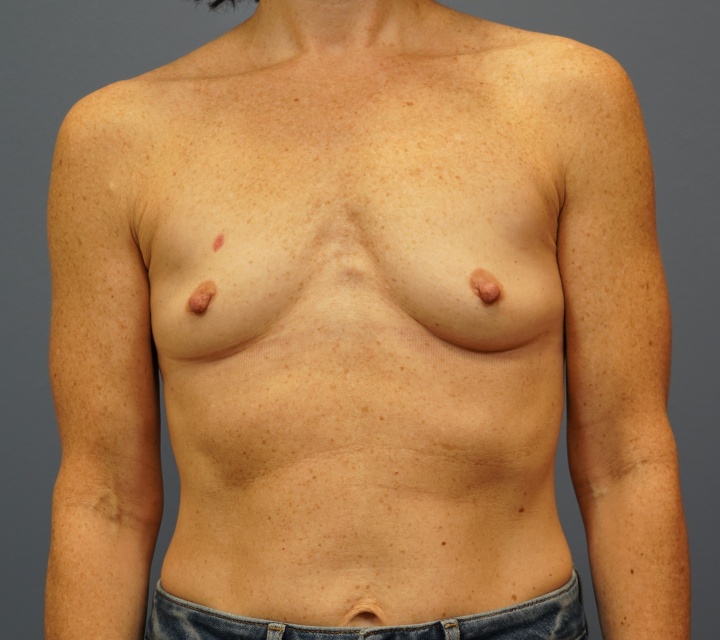 before and after breast augmentation