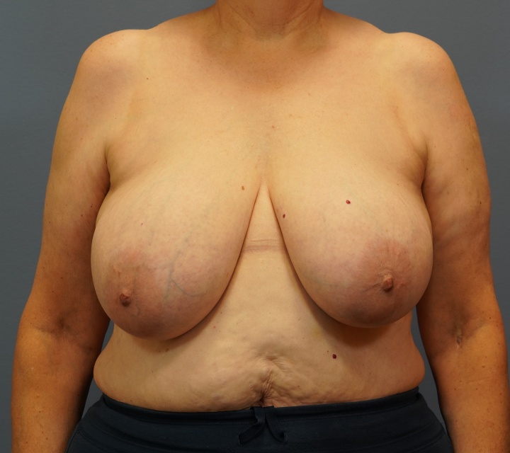 breast reduction before and after