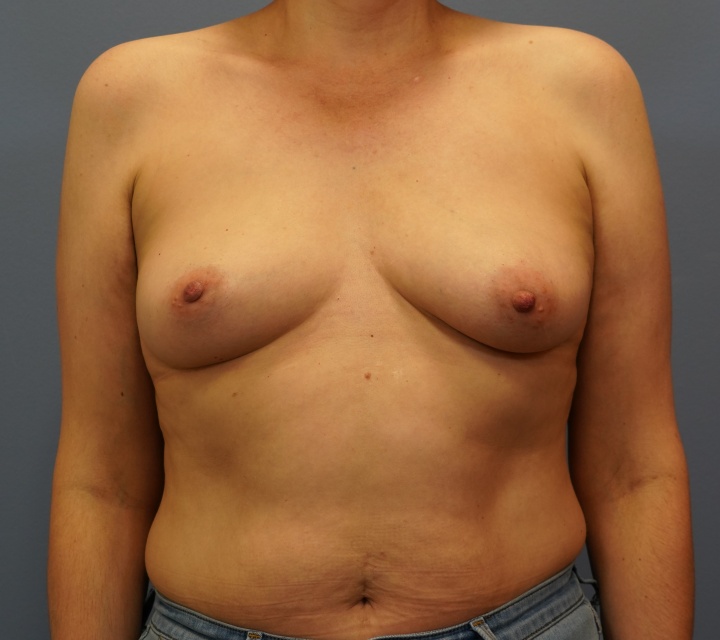 breast cancer reconstruction