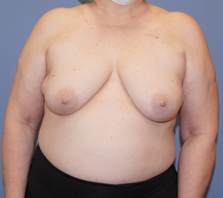 breast cancer reconstruction