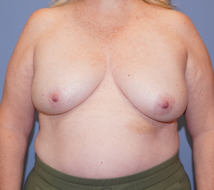 breast cancer reconstruction
