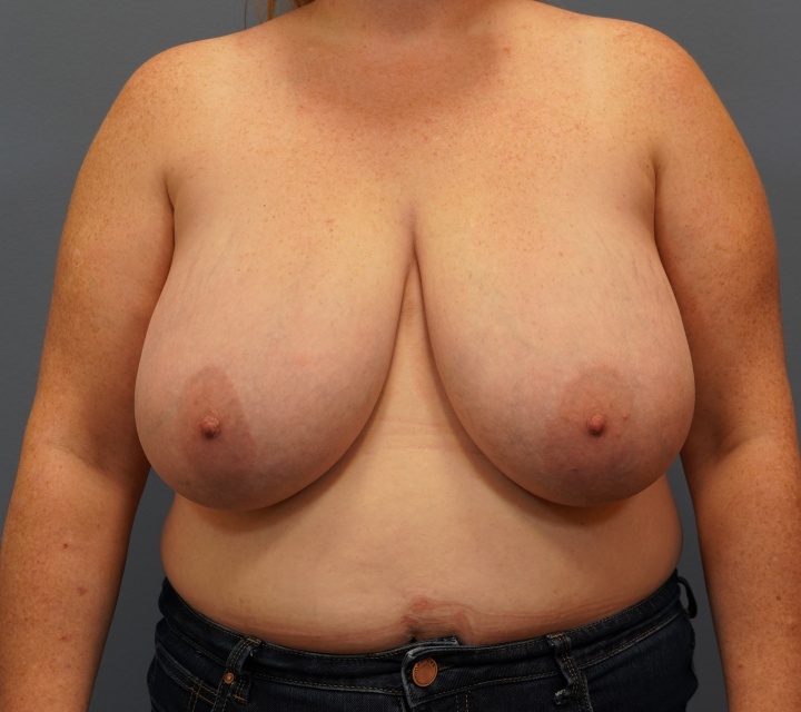breast reduction before and after