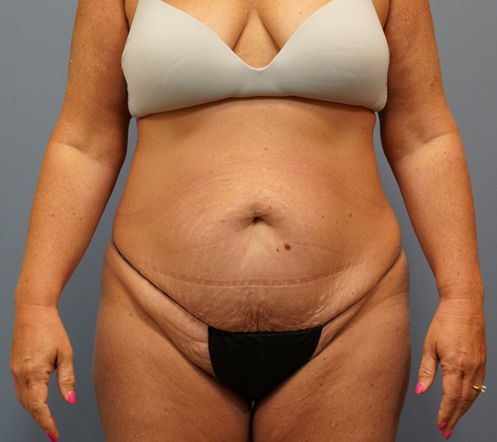before liposuction