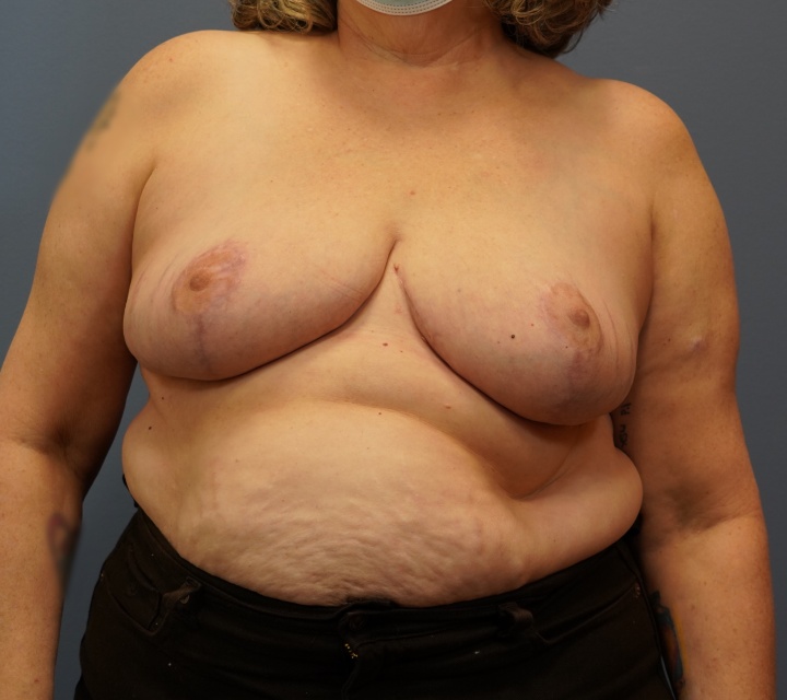 breast reduction before and after