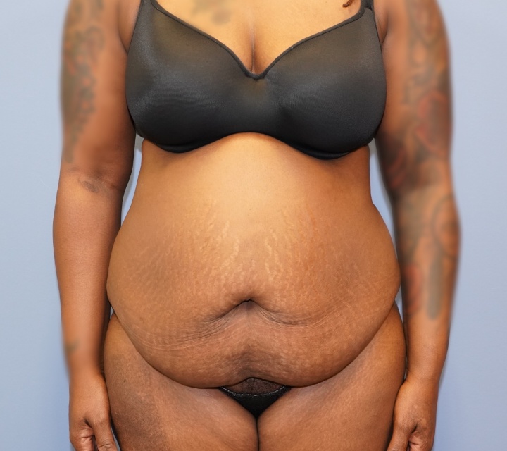 before liposuction