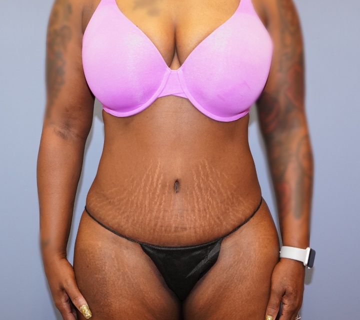 after liposuction