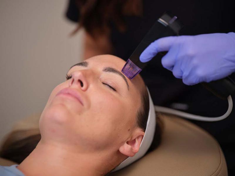 microneedling treatment