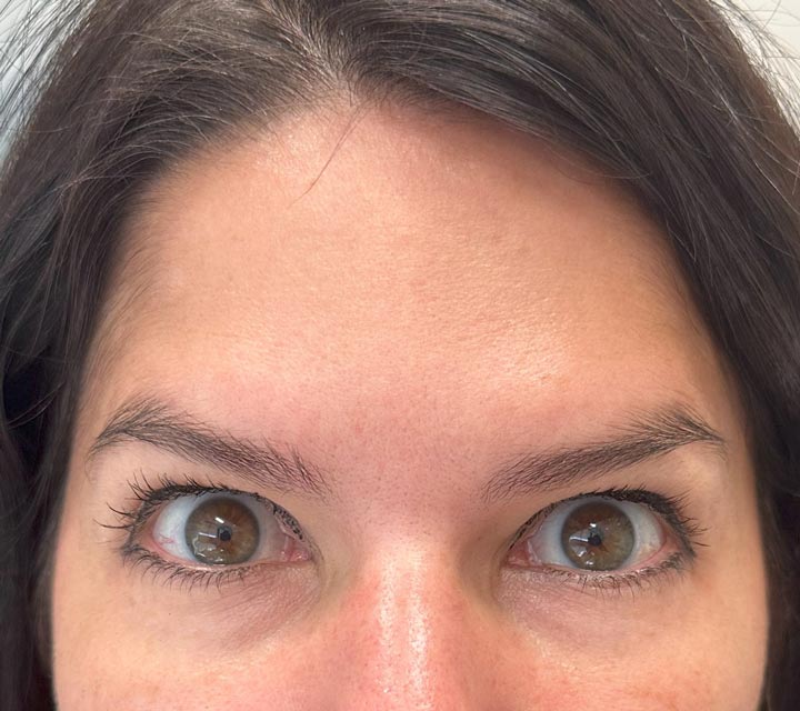 after Botox treatment