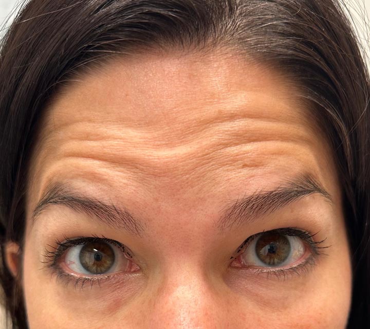 Before Botox treatment