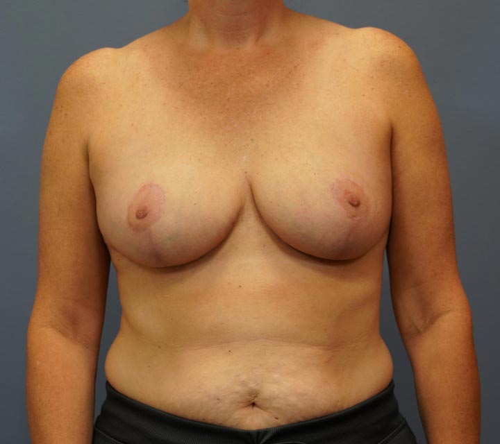 after breast reduction