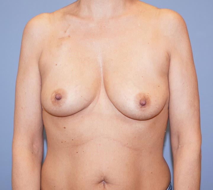 before breast cancer reconstruction surgery